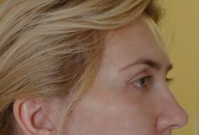 lazernay shlifovka лазерная шлифовка