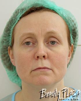 лазерная шлифовка