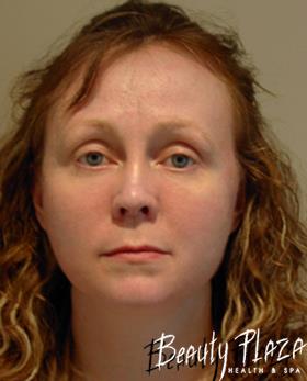 лазерная шлифовка